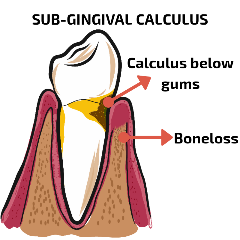 calculus below gingiva