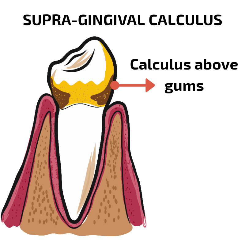 calculus above gums