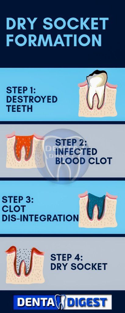 image showing dry socket formation