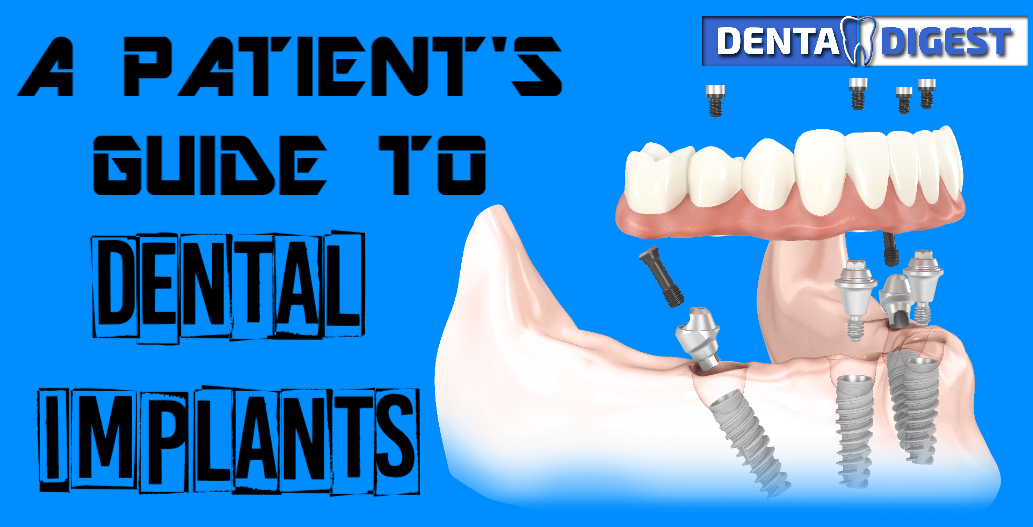 dental implants