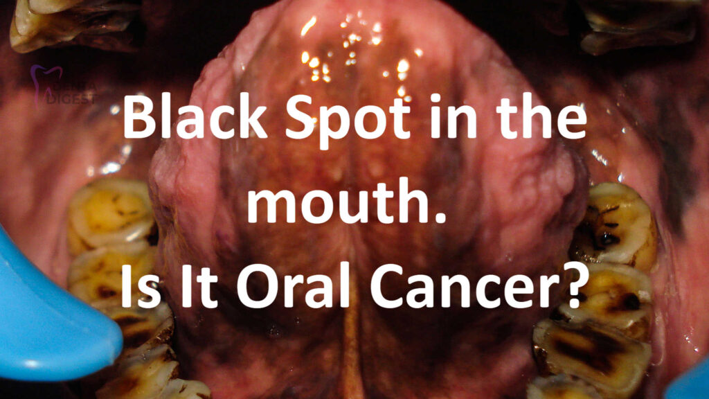 Black spot on gums. Is it oral cancer?