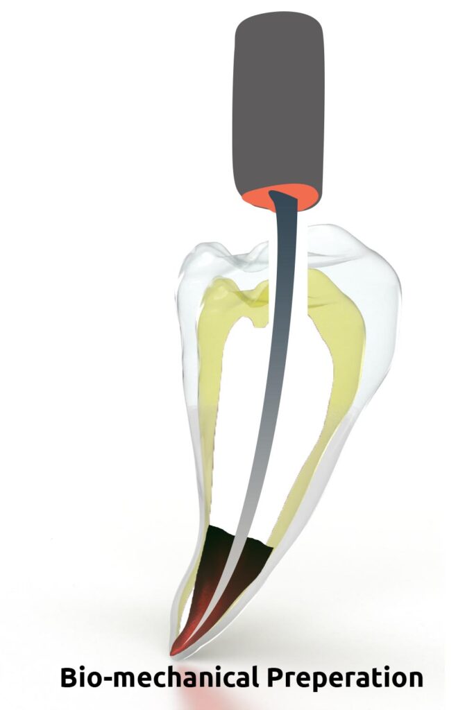 Root canal treatment. everything you need to know