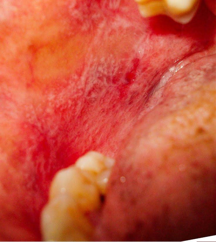 lichen planus on buccal mucosa