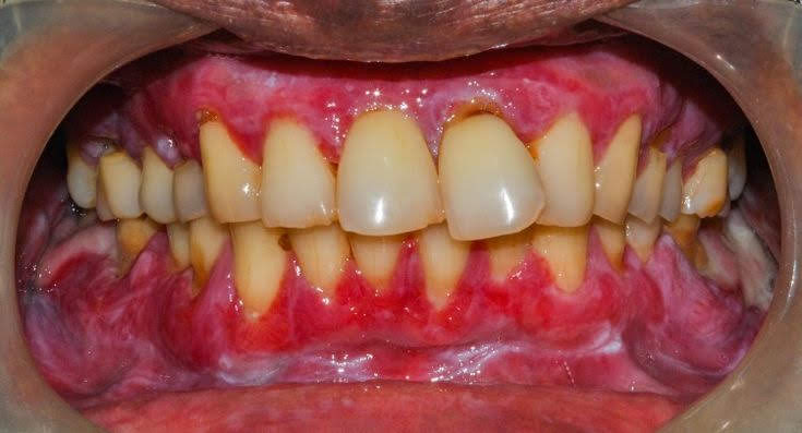 Oral lichen planus cancer symptoms