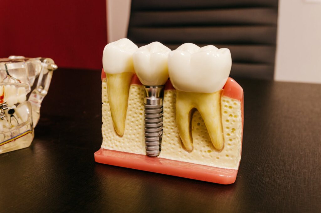 9 myths about Dental Implant Restorations