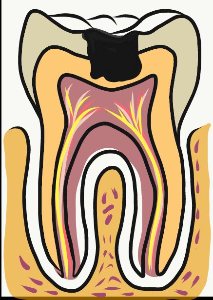 Caries in enamel and dentin