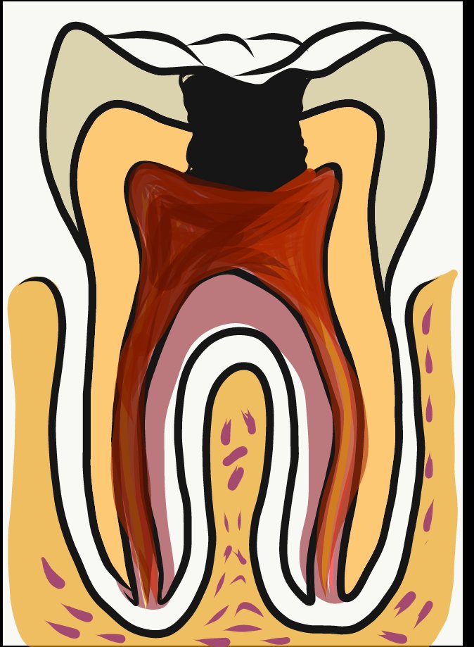 Picture showing caries involving pulp