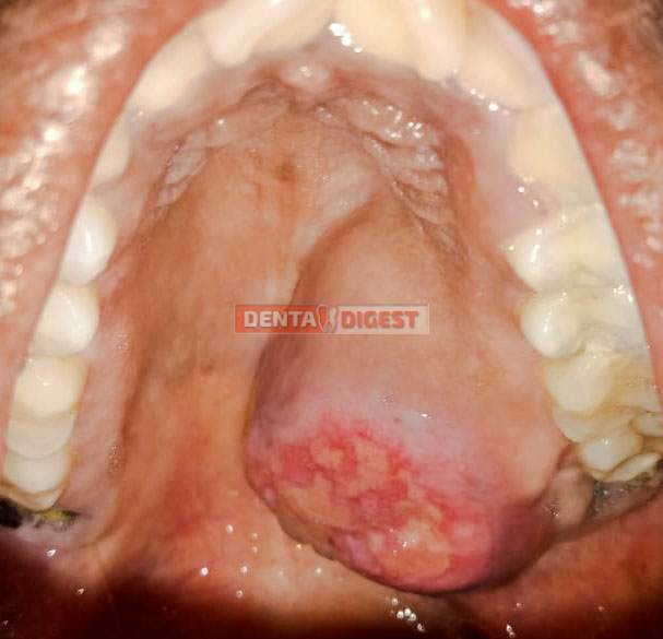 oral cancer