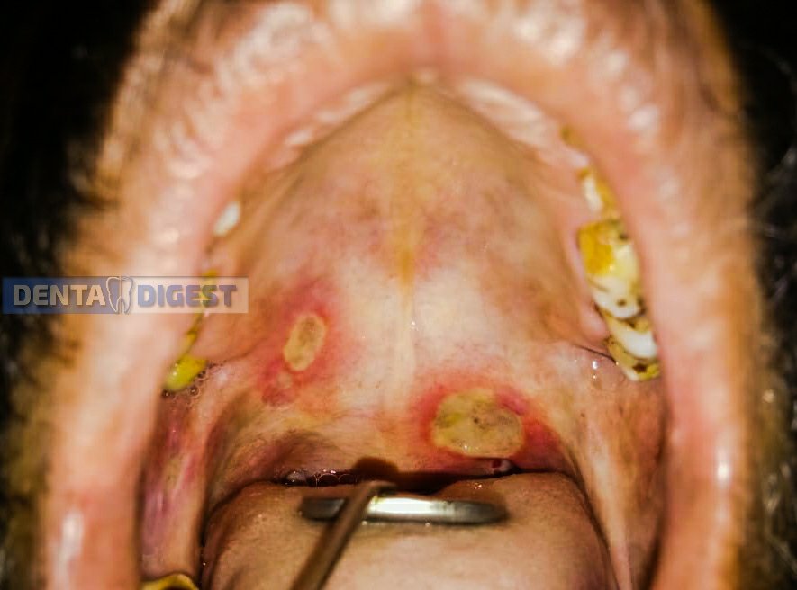 MAJOR CANKER SORE AT BACK OF PALATE