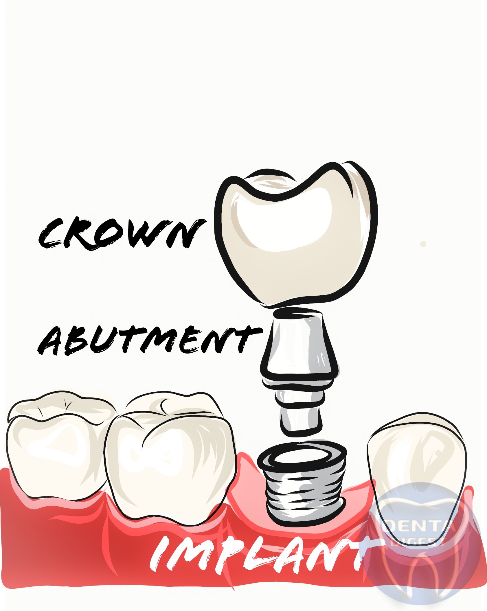 DENTAL IMPLANT RESTORATION. WHAT TO EXPECT, PROCEDURE, AND ...