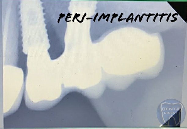 peri-implantitis