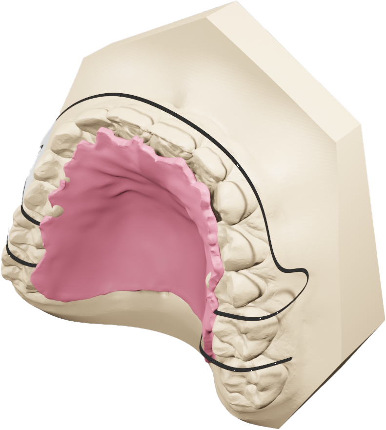 removable retainer