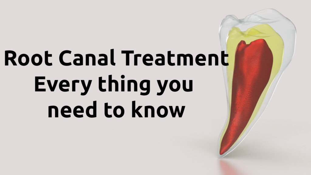 Root canal treatment. everything you need to know