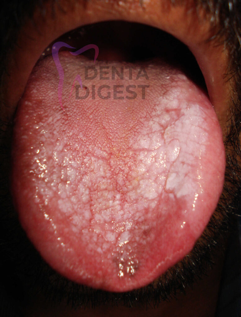 leukoplakia on tongue