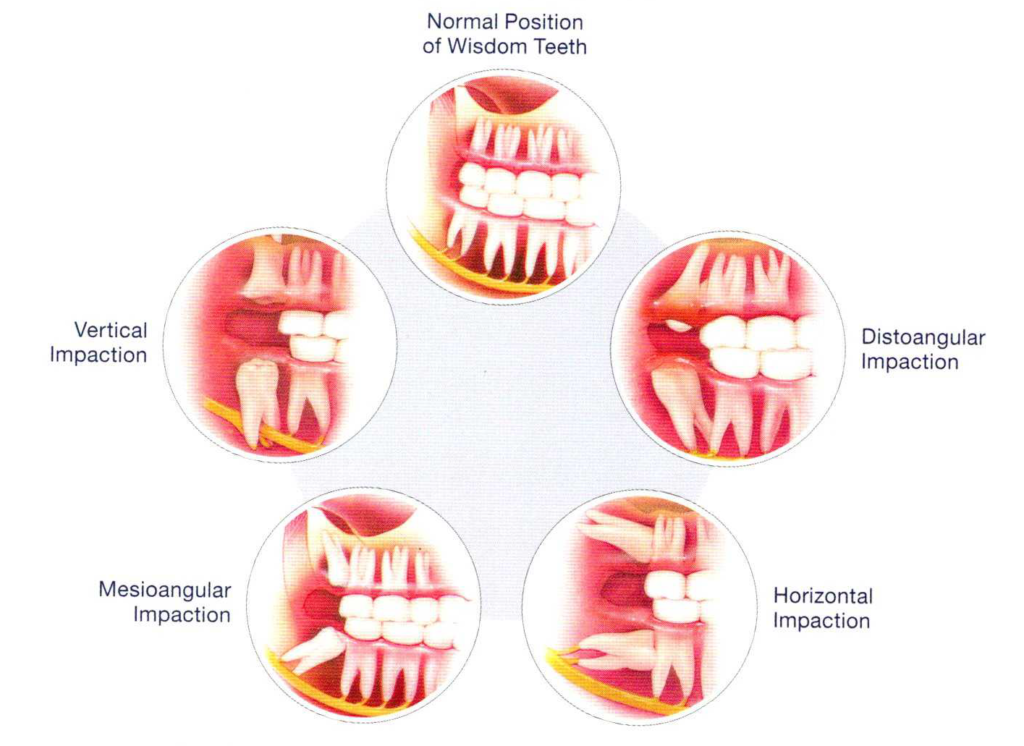 position of impacted teeth